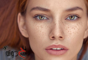 تفسير رؤية النمش في المنام