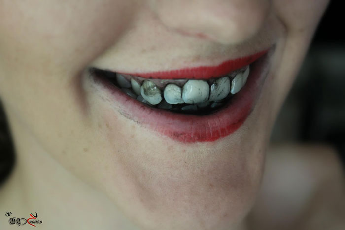 تفسير رؤية الاسنان السوداء في المنام