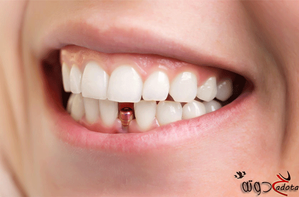 تفسير رؤية خلع الناب باليد في المنام